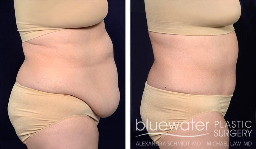 A result from Blue Water Plastic Surgery Partners