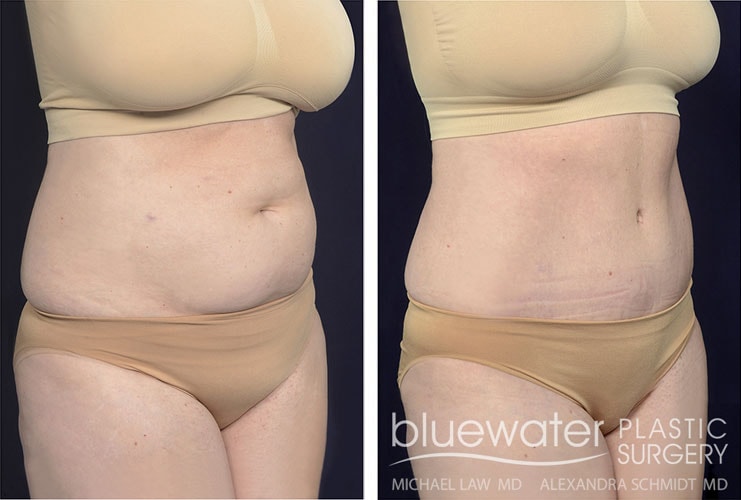 A result from Blue Water Plastic Surgery Partners