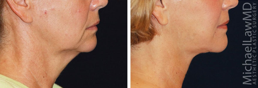 A result from Blue Water Plastic Surgery Partners