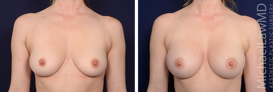 A result from Blue Water Plastic Surgery Partners
