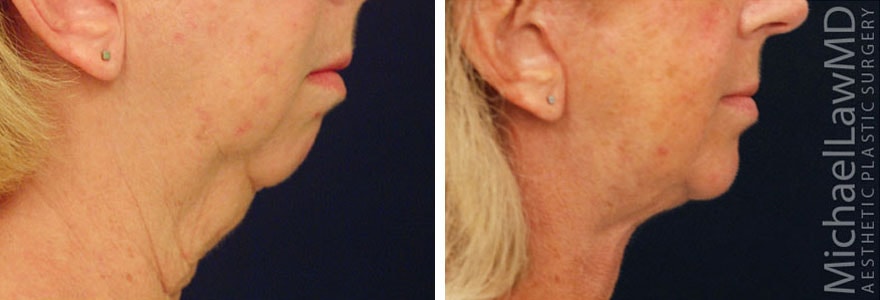 A result from Blue Water Plastic Surgery Partners