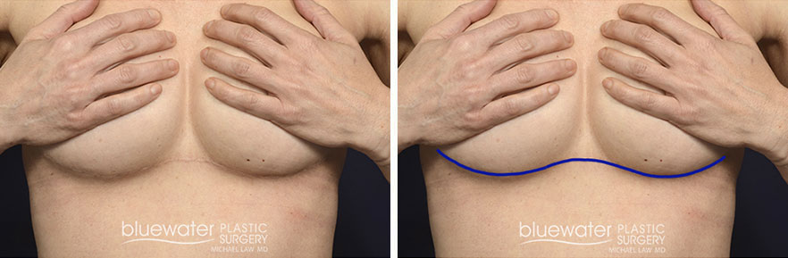 A result from Blue Water Plastic Surgery Partners