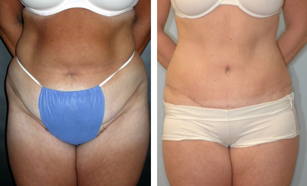 A result from Handler Barry S MD: Cosmetic & Reconstructive Surgery