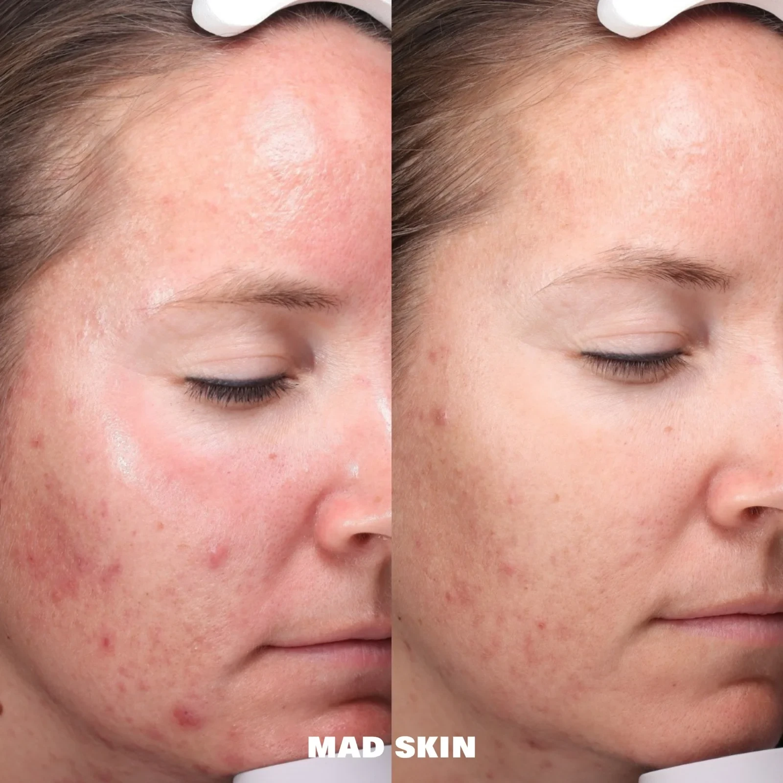 A result from MAD SKIN