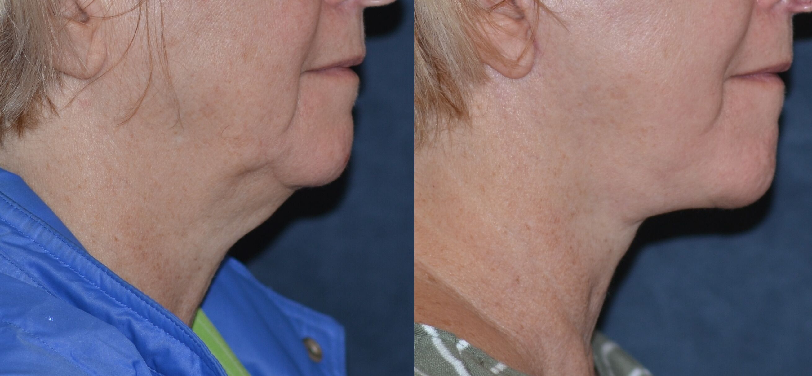 A result from Winslow Facial Plastic Surgery: Catherine Winslow MD