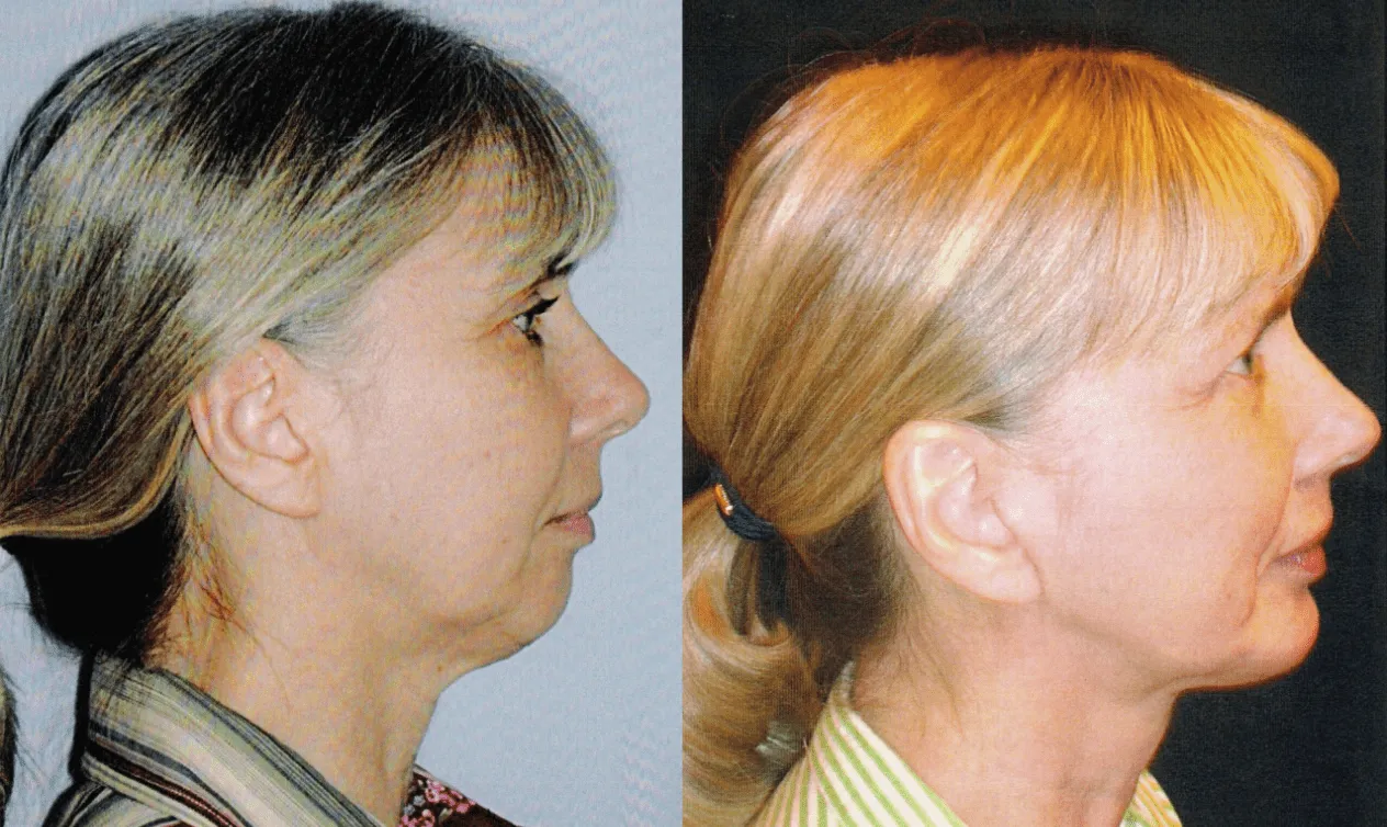 A result from Winslow Facial Plastic Surgery: Catherine Winslow MD