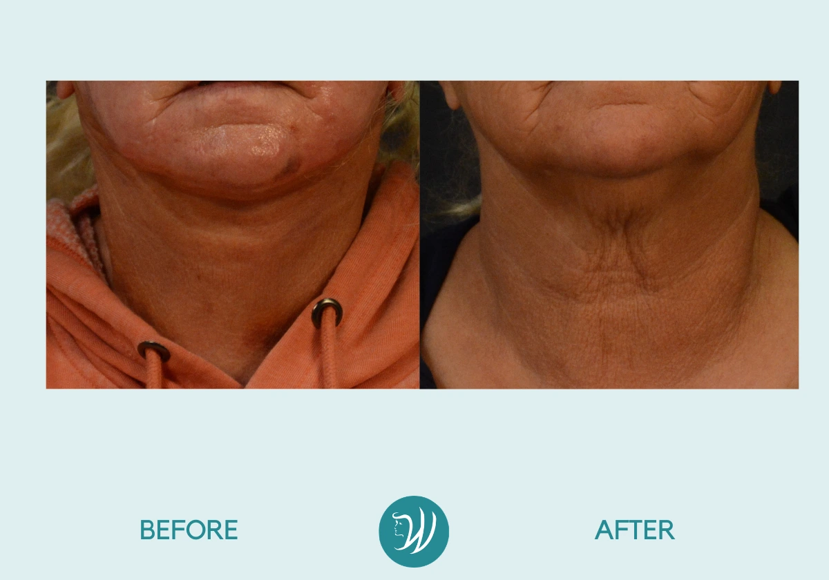 A result from Winslow Facial Plastic Surgery: Catherine Winslow MD