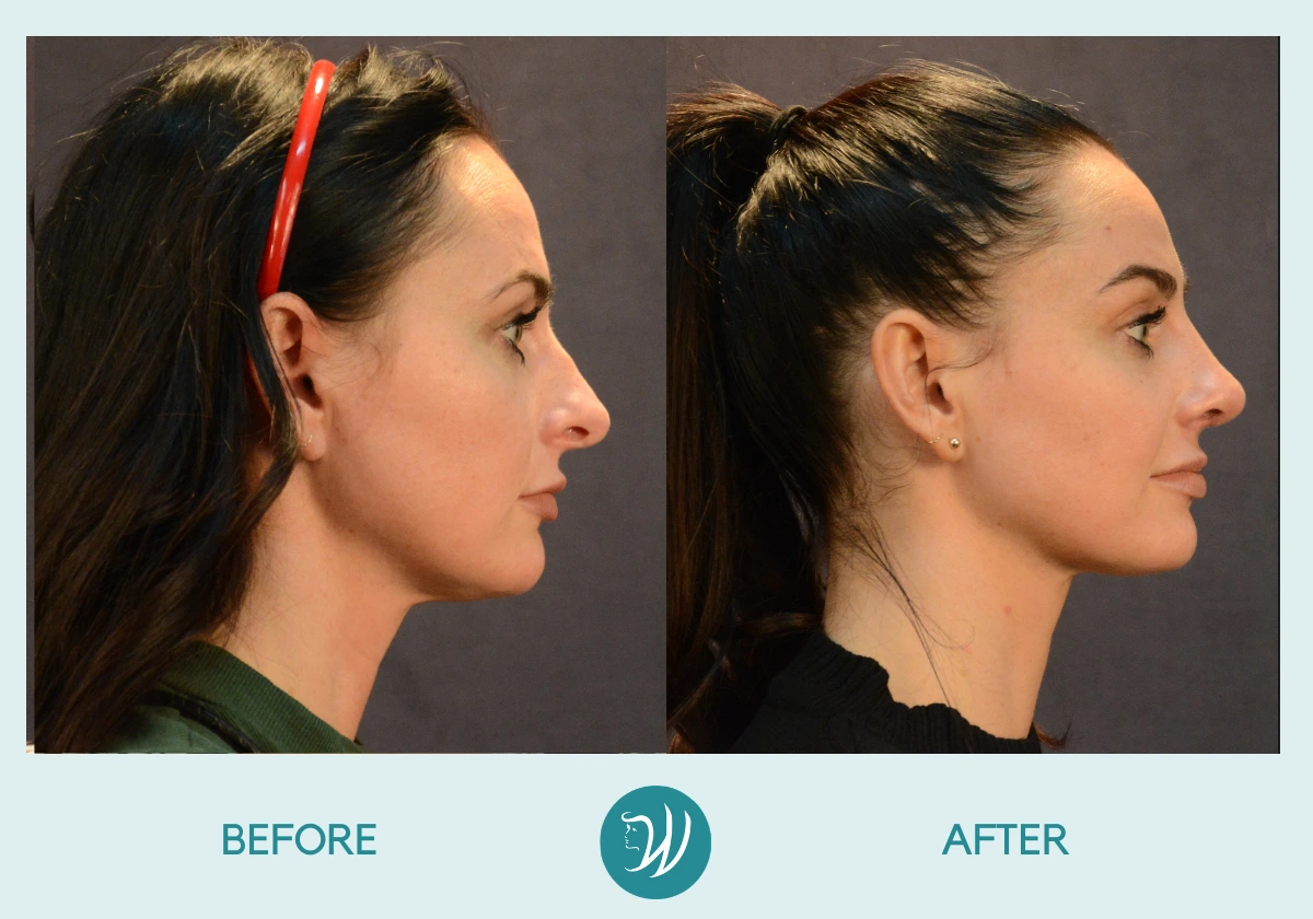 A result from Winslow Facial Plastic Surgery: Catherine Winslow MD