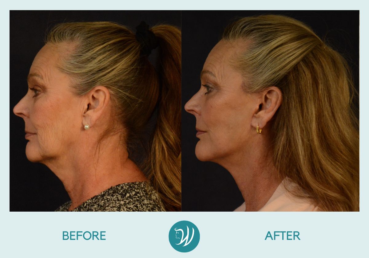 A result from Winslow Facial Plastic Surgery: Catherine Winslow MD