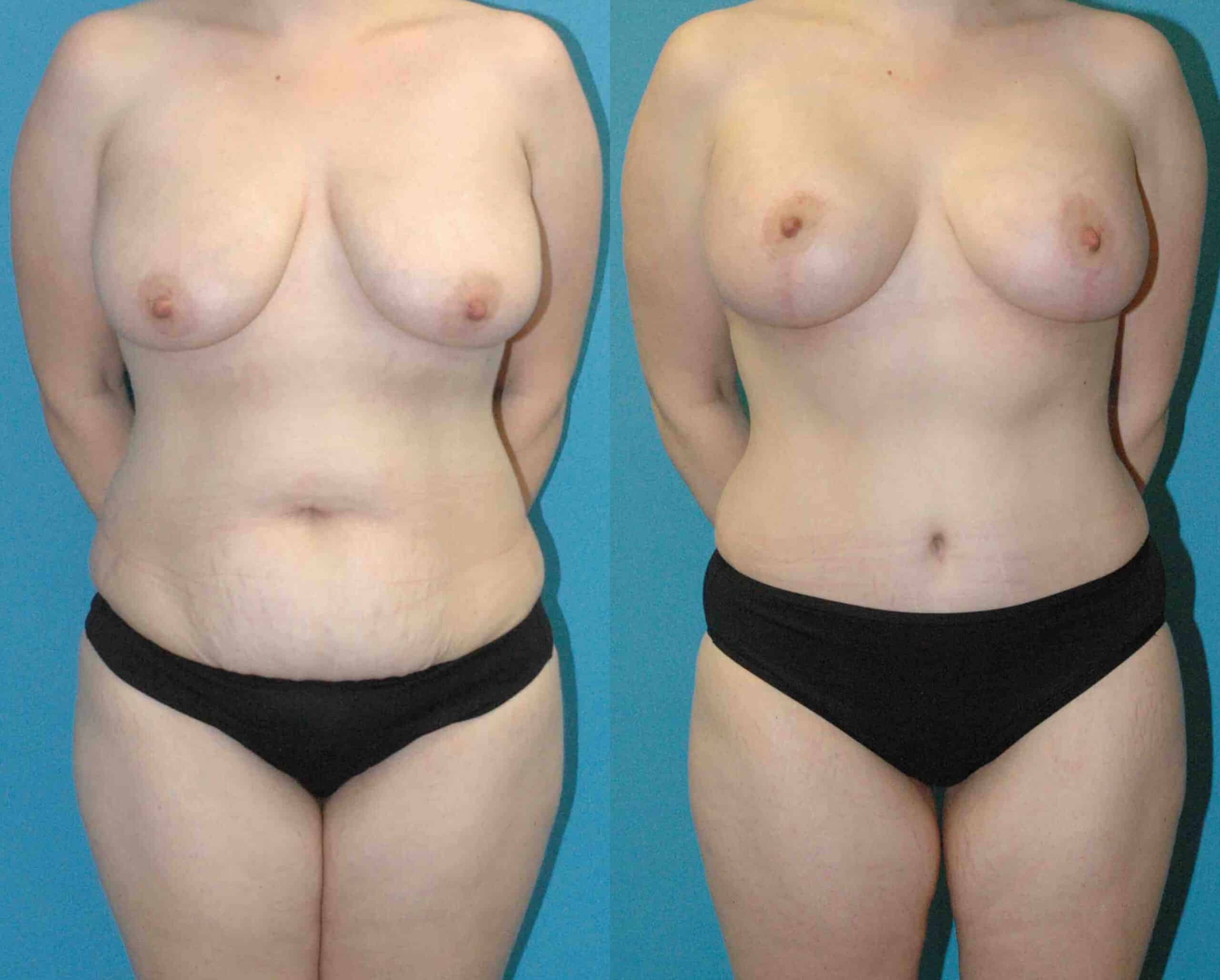 A result from Sound Plastic Surgery