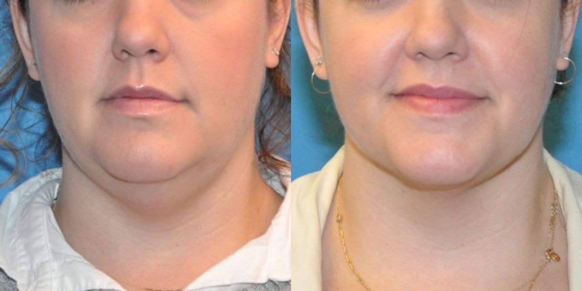 A result from Sound Plastic Surgery