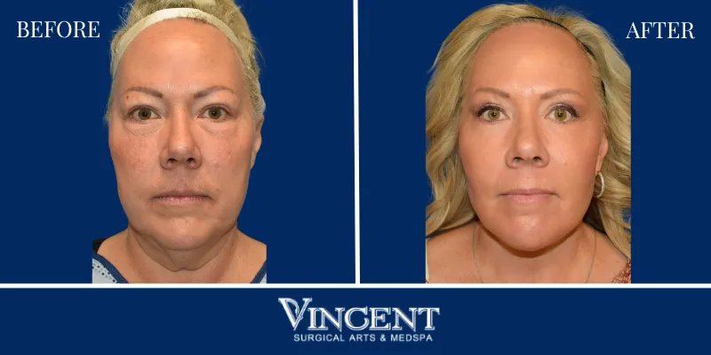 A result from Vincent Surgical Arts
