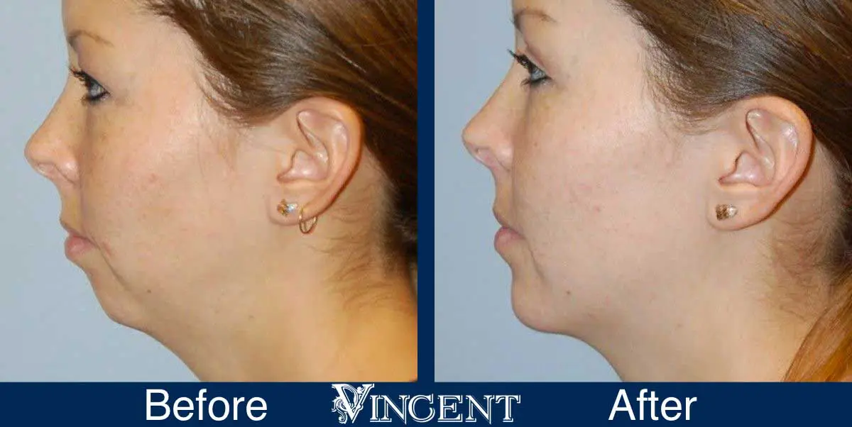 A result from Vincent Surgical Arts