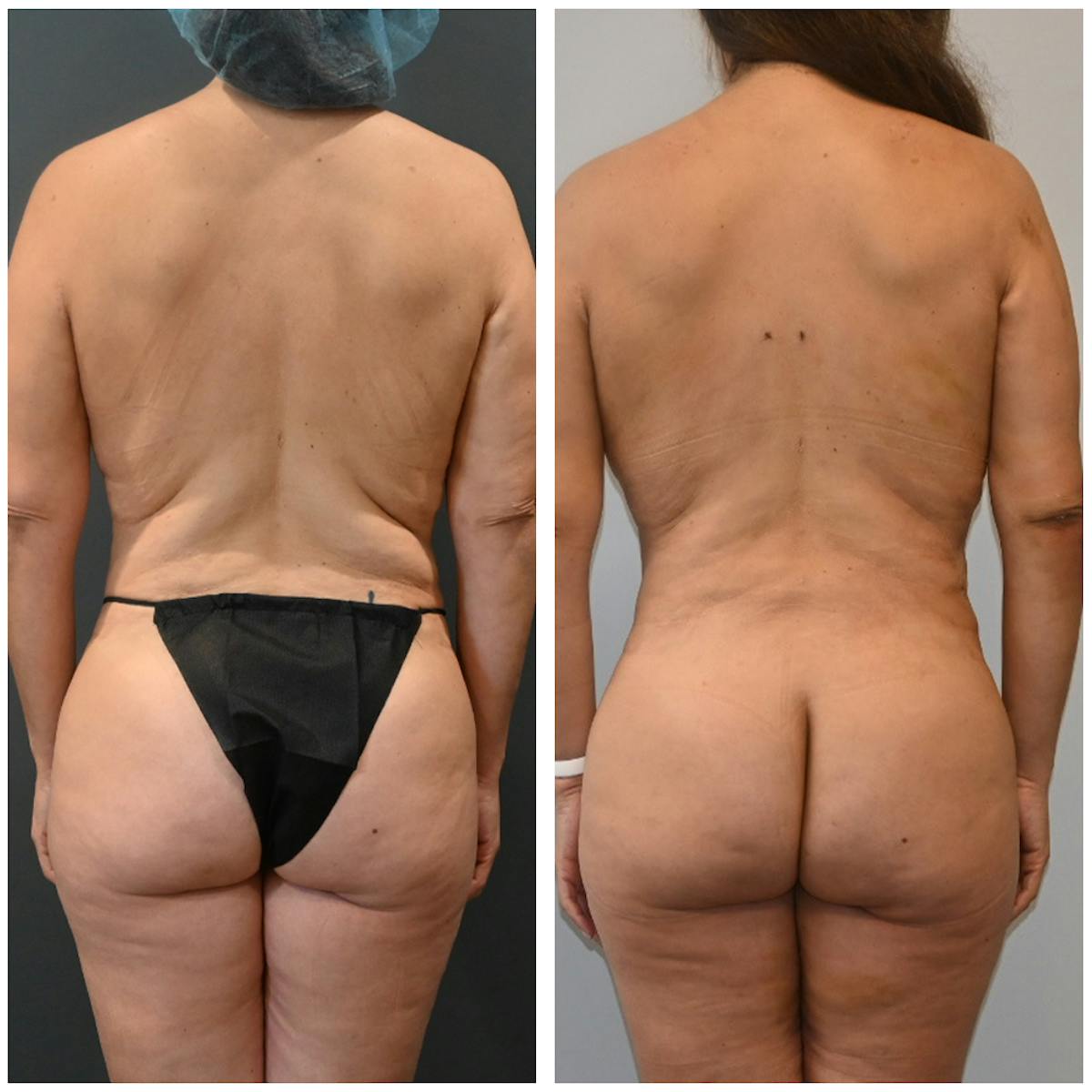 A result from Dr. Brian Shafa Plastic Surgery