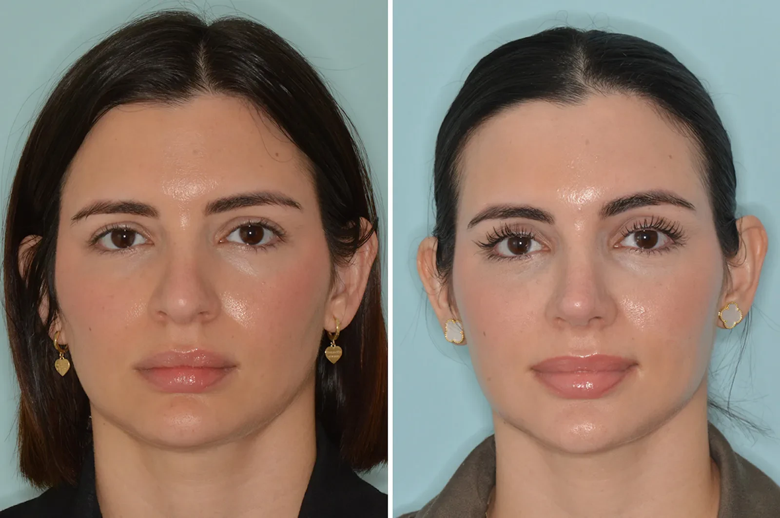 A result from Dr. Anthony Bared Facial Plastic Surgery