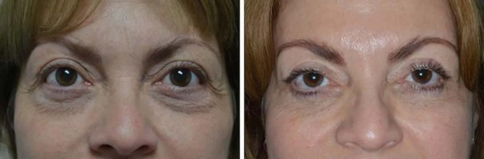 A result from Dr. Anthony Bared Facial Plastic Surgery