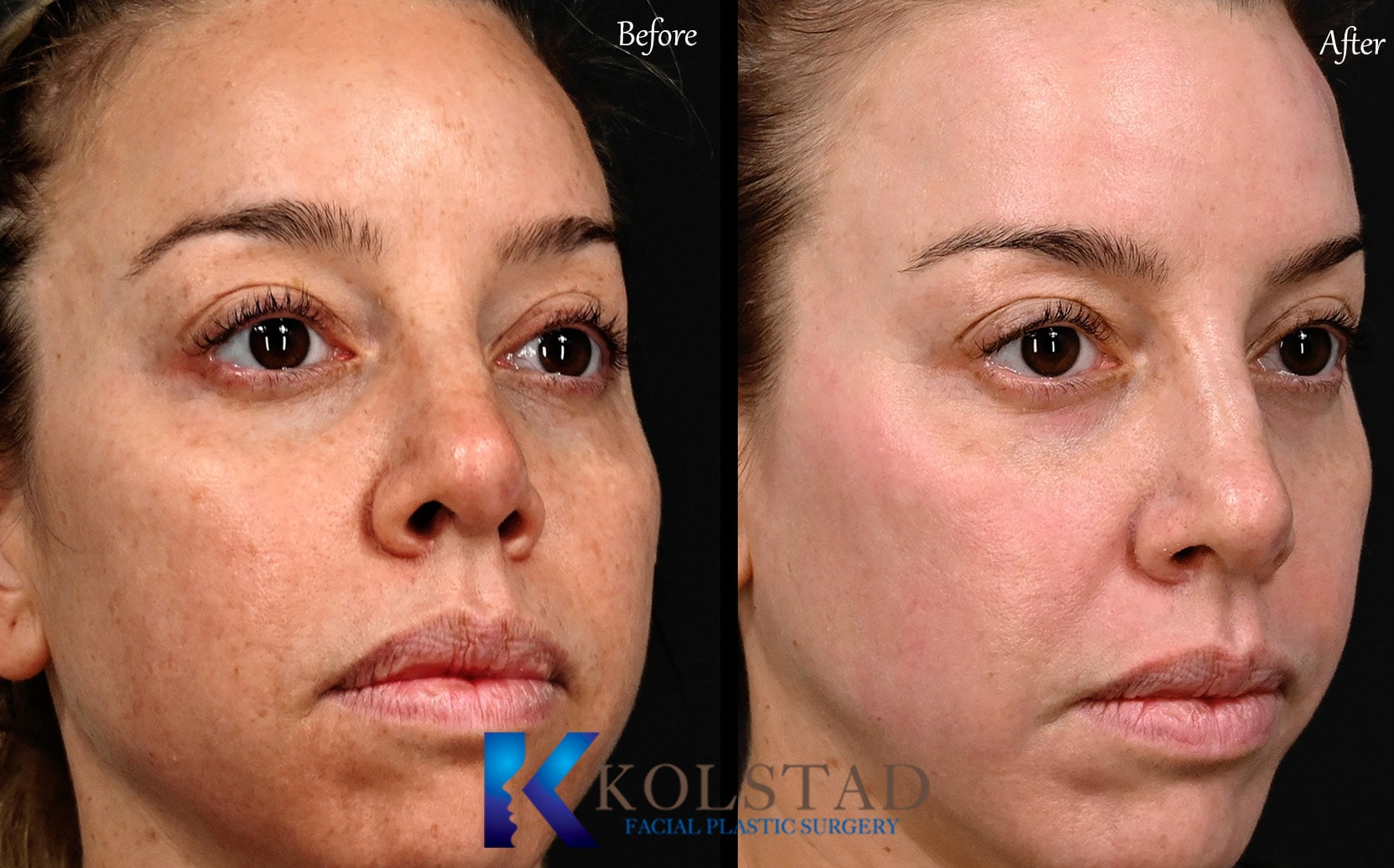 A result from Kolstad Facial Plastic Surgery