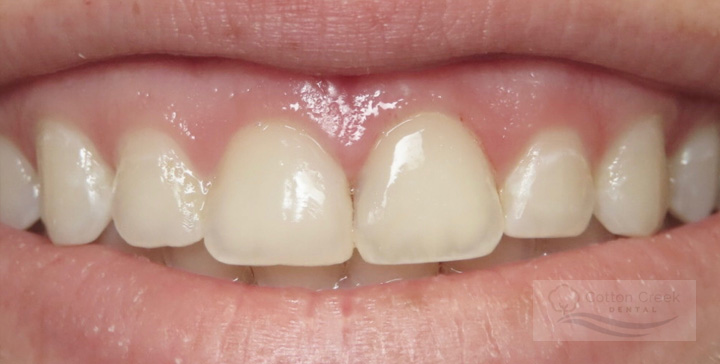 Cotton Creek Dental veneers after — Washington, UT
