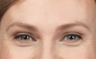 Procedure before photo