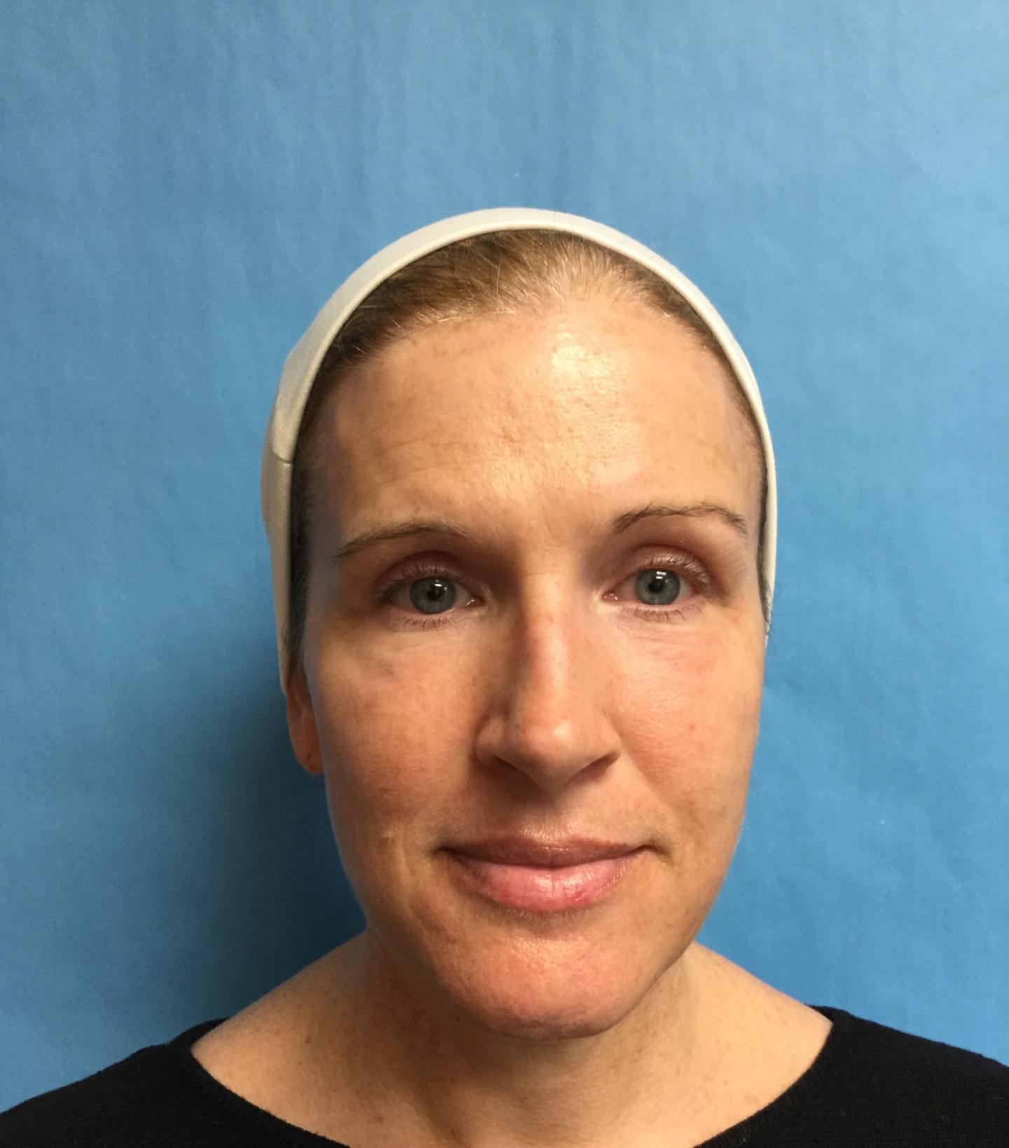 A result from Zormeier Cosmetic Surgery and Longevity Center
