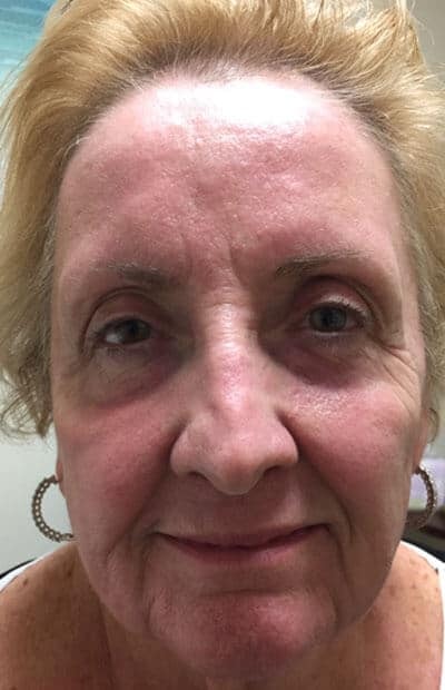 A result from Zormeier Cosmetic Surgery and Longevity Center