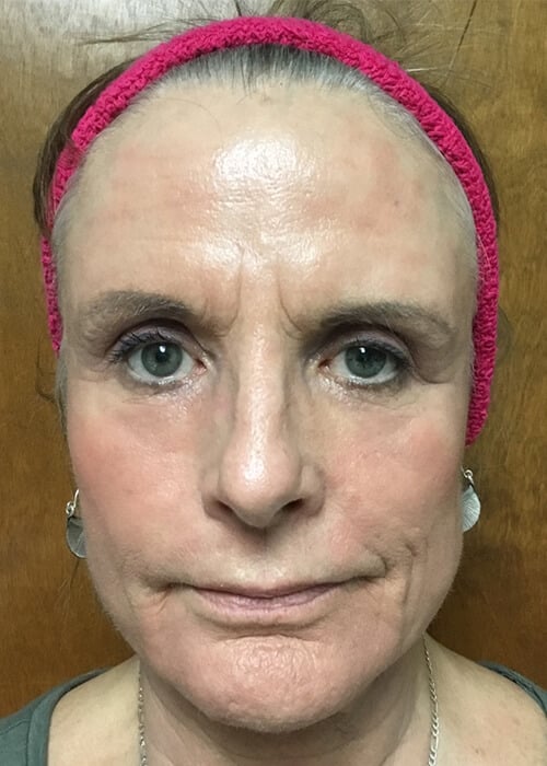 A result from Zormeier Cosmetic Surgery and Longevity Center