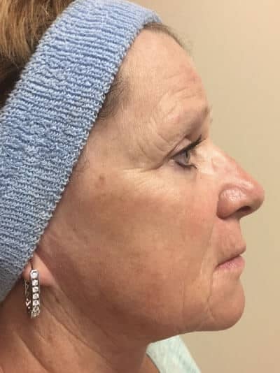 A result from Zormeier Cosmetic Surgery and Longevity Center