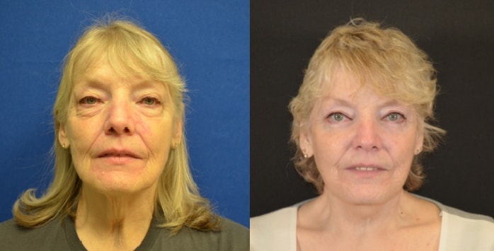 A result from Hetal Fichadia, MD, FACS