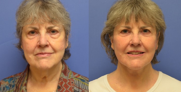 A result from Hetal Fichadia, MD, FACS