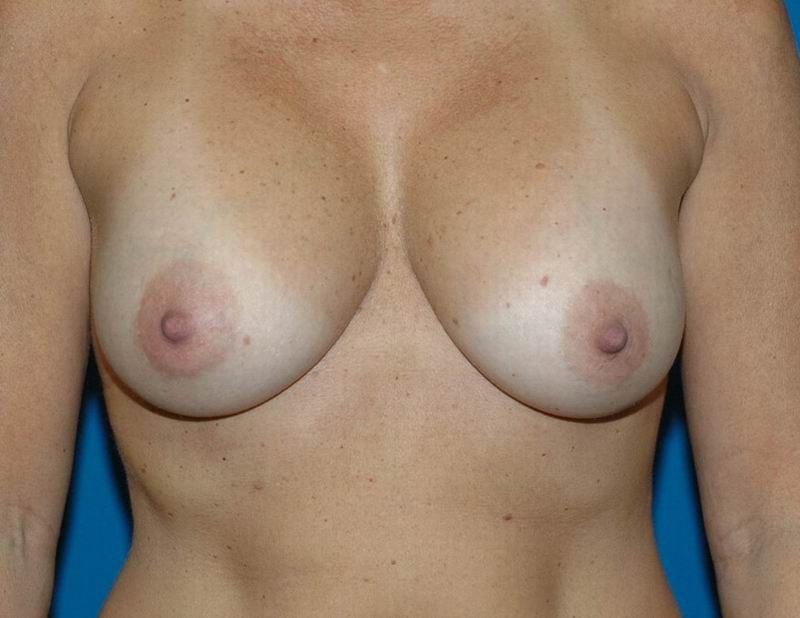 A result from Naficy Plastic Surgery & Rejuvenation Center