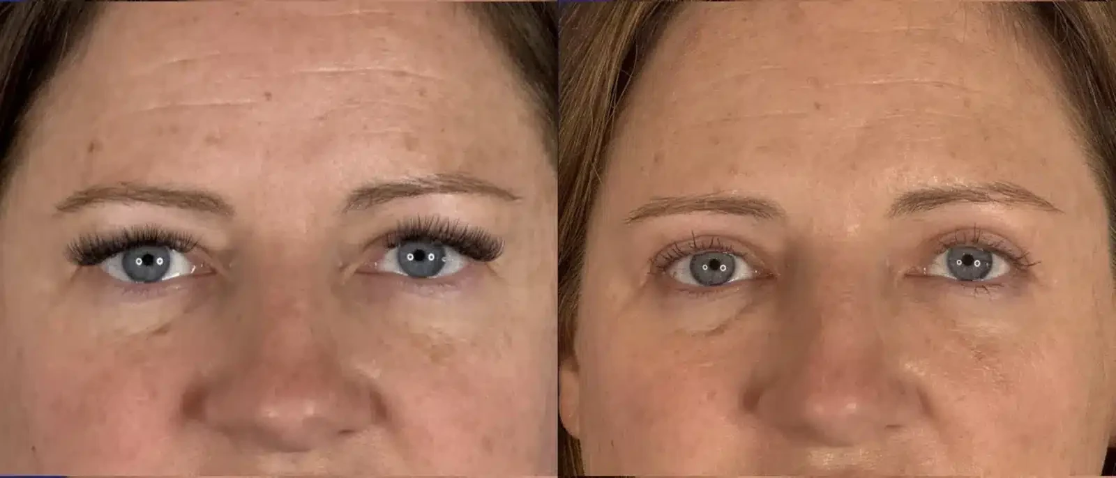A result from Troell Cosmetic Surgery & Facial Plastic Clinic
