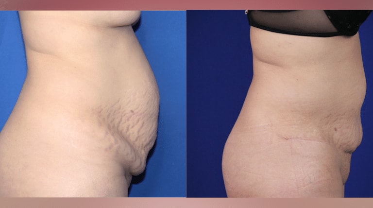 A result from Troell Cosmetic Surgery & Facial Plastic Clinic