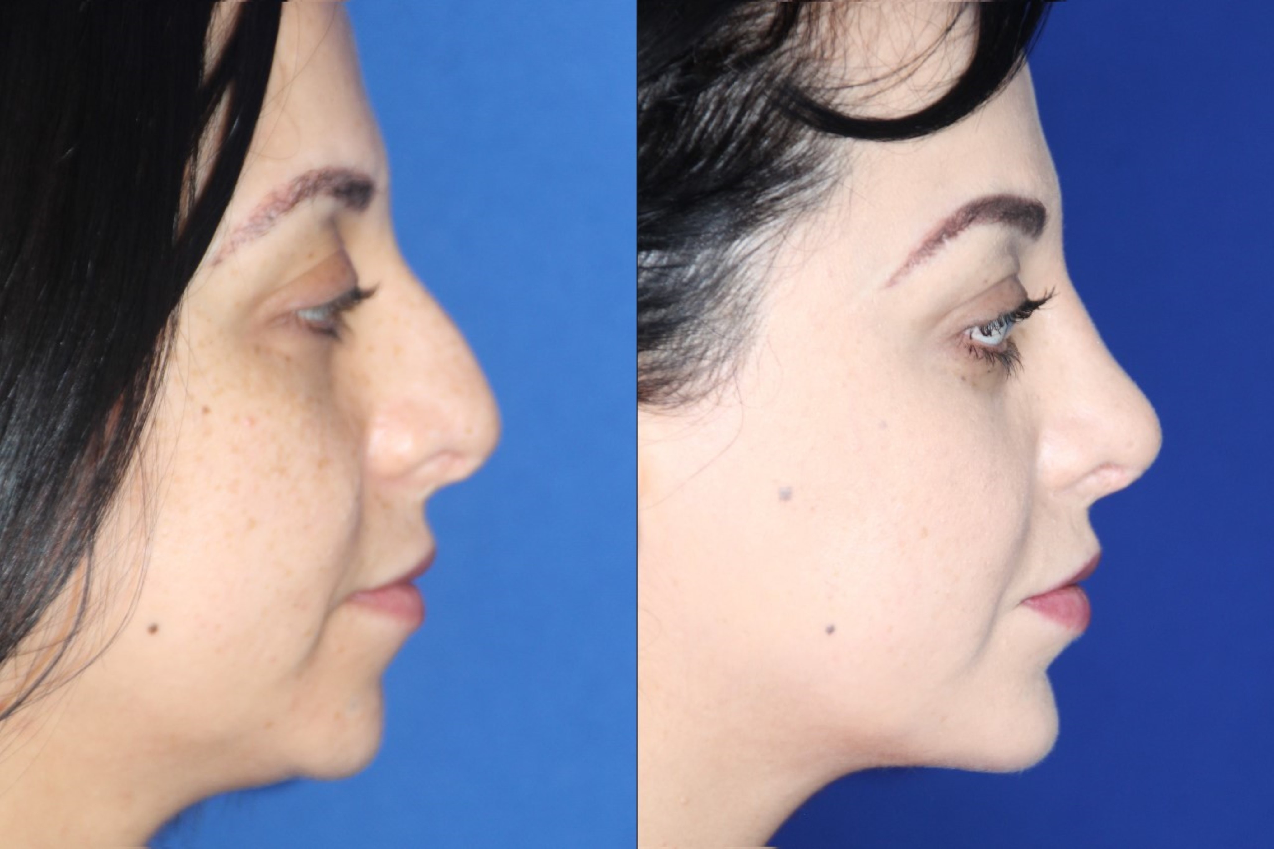 A result from Troell Cosmetic Surgery & Facial Plastic Clinic