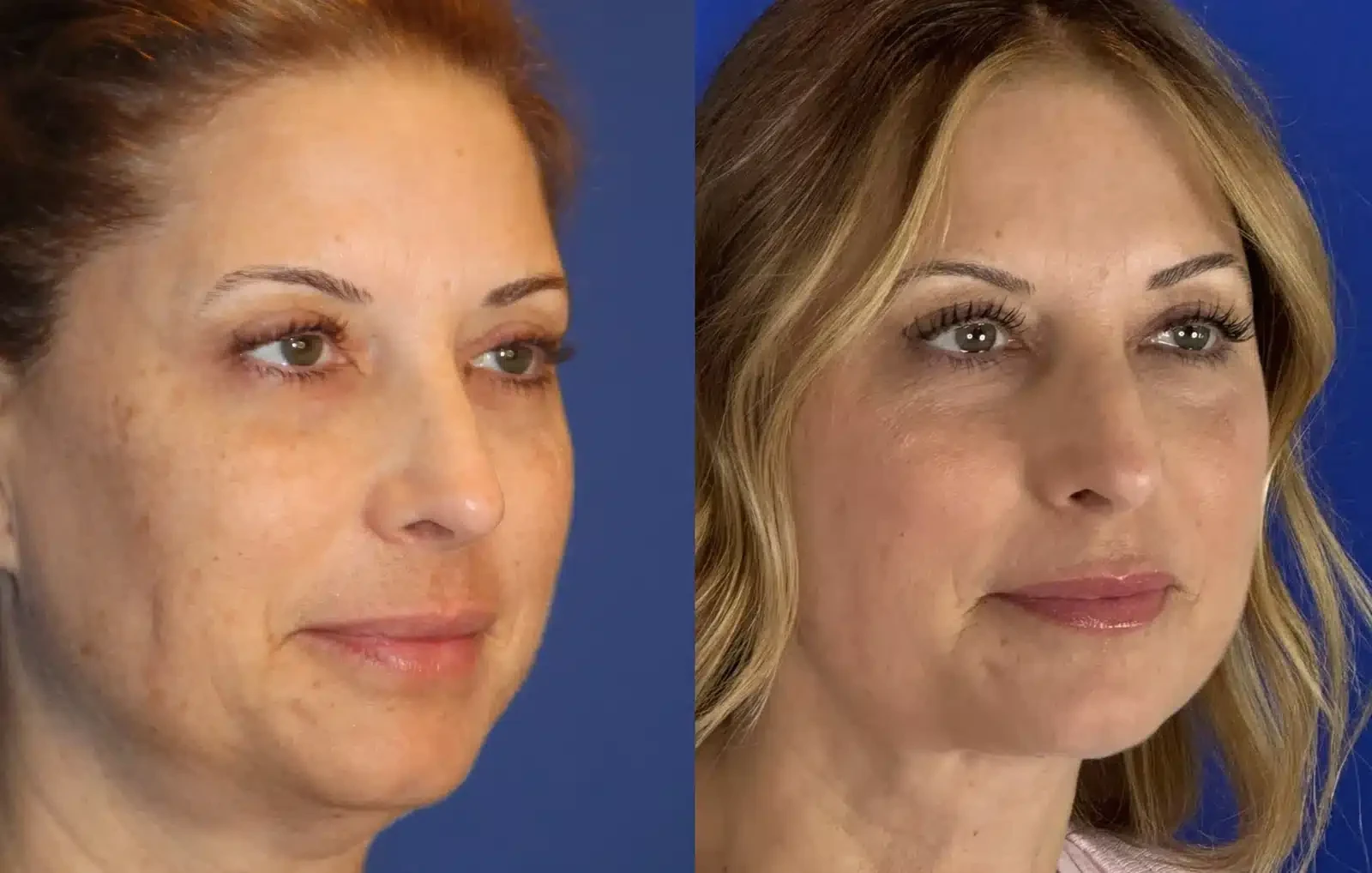 A result from Troell Cosmetic Surgery & Facial Plastic Clinic