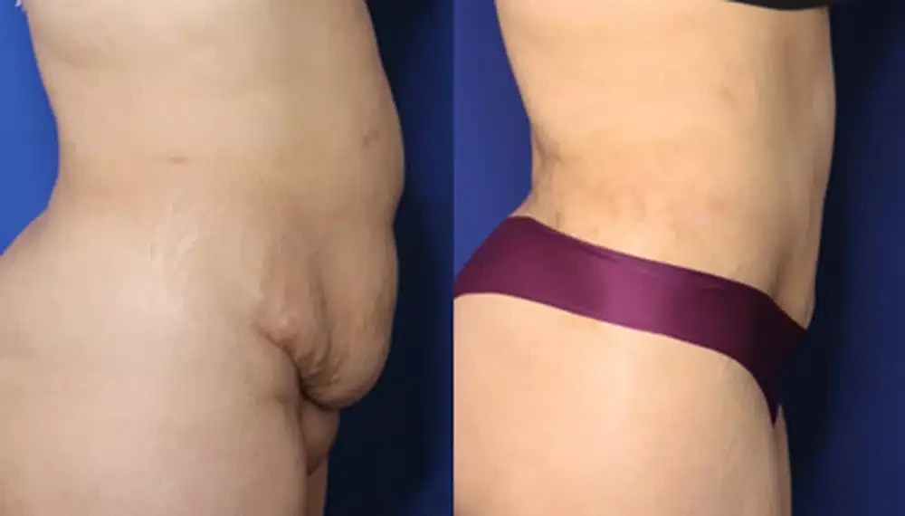 A result from Troell Cosmetic Surgery & Facial Plastic Clinic