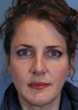 A result from Romo Plastic Surgery