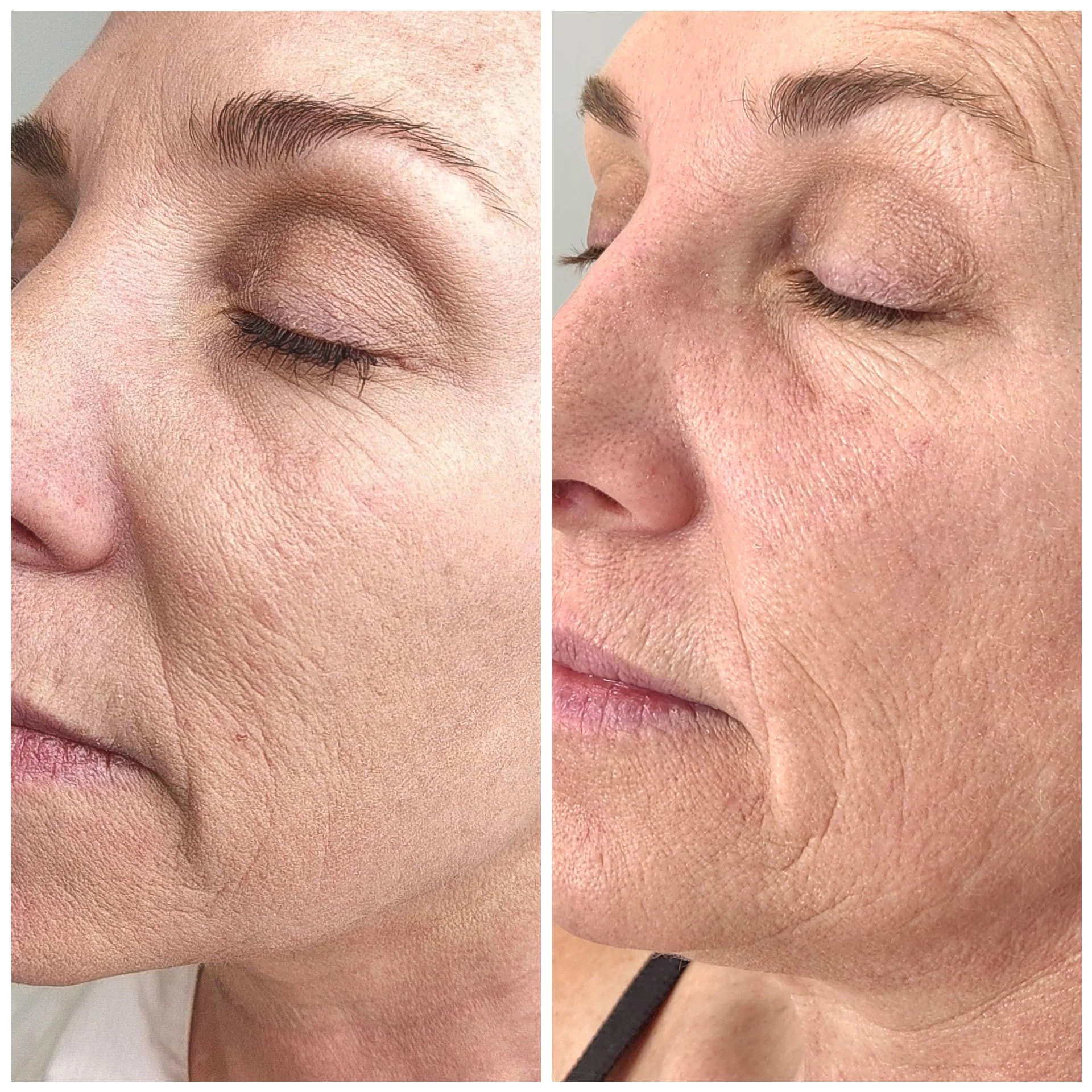 A result from Bocaba Medspa