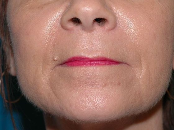 A result from Carmel Cosmetic and Plastic Surgeons
