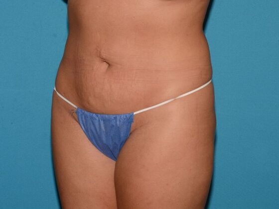 A result from Carmel Cosmetic and Plastic Surgeons