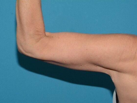 A result from Carmel Cosmetic and Plastic Surgeons