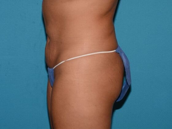 A result from Carmel Cosmetic and Plastic Surgeons