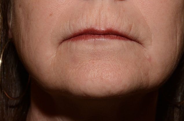 A result from Carmel Cosmetic and Plastic Surgeons