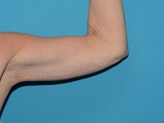 A result from Carmel Cosmetic and Plastic Surgeons