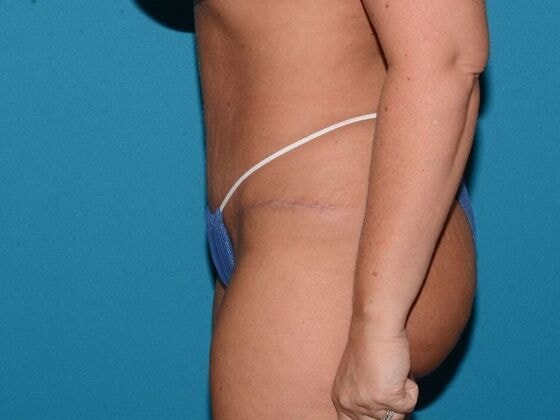 A result from Carmel Cosmetic and Plastic Surgeons