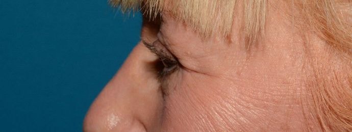 A result from Carmel Cosmetic and Plastic Surgeons