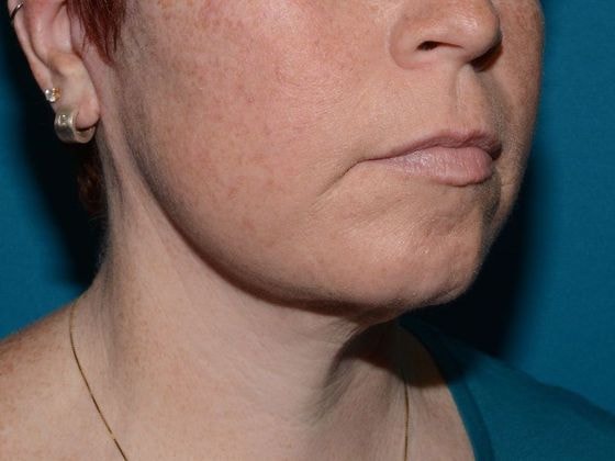 A result from Carmel Cosmetic and Plastic Surgeons