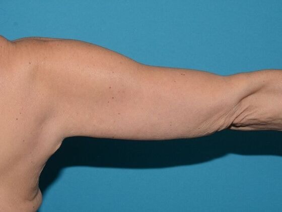 A result from Carmel Cosmetic and Plastic Surgeons