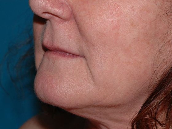 A result from Carmel Cosmetic and Plastic Surgeons