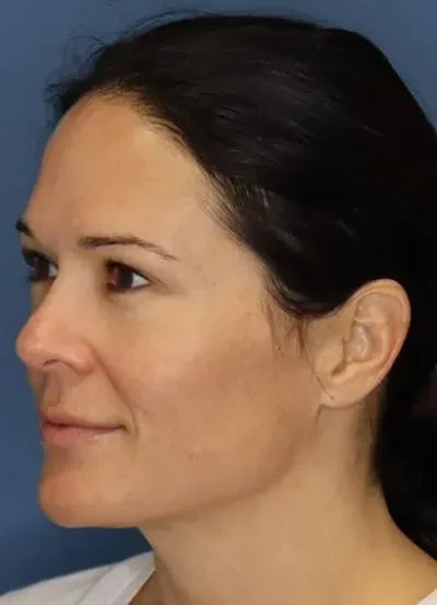 A result from South Coast Plastic Surgery Ladera Ranch