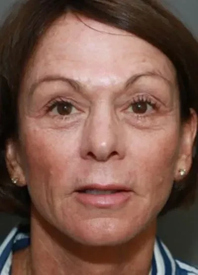A result from South Coast Plastic Surgery Ladera Ranch